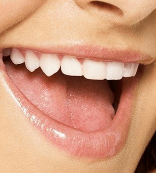 Dental Veneers